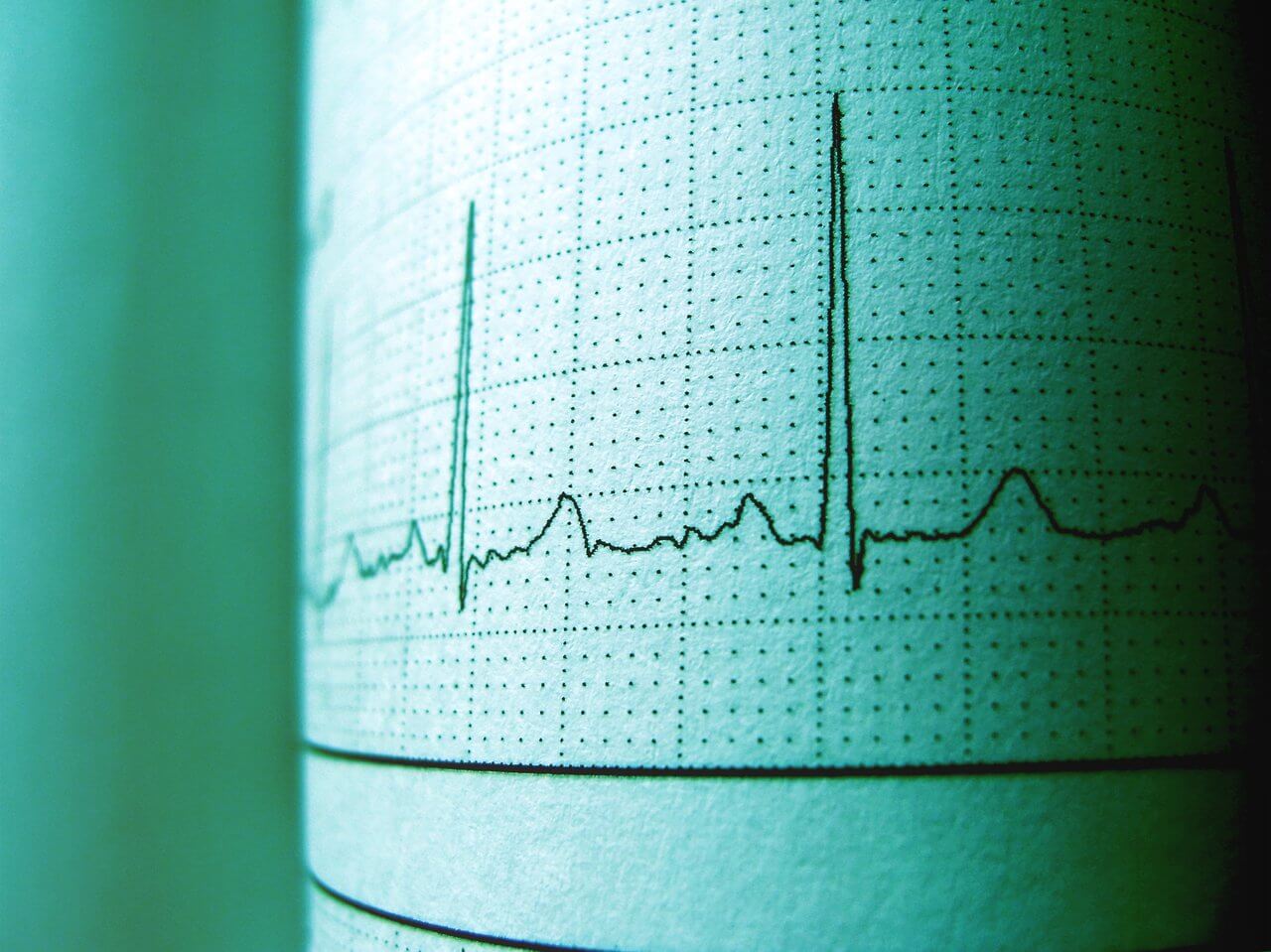 Understanding Heart Palpitations Causes, Symptoms & Treatment