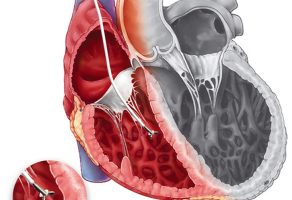 Endomyocardial Biopsy